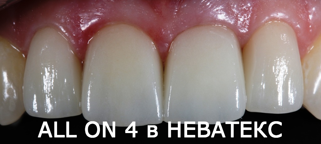 Операция по восстановлению зубов за 1 день зубы за 1 день